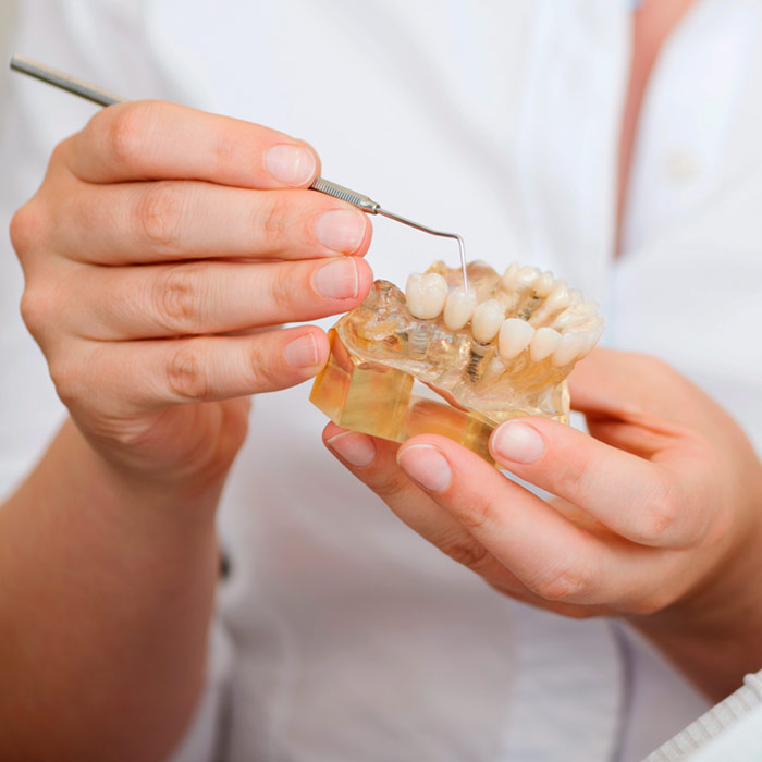 Vantagens dos implantes dentários